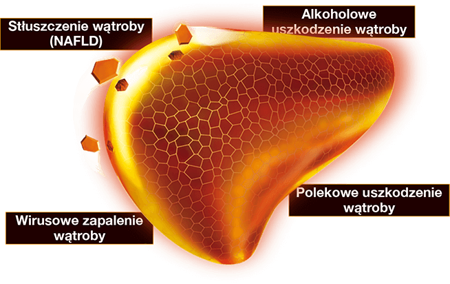 Najczęstsze choroby wątroby