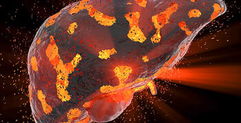 Czy stłuszczenie wątroby jest groźne? Poznaj dane!